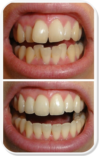 ارتودنسی ثابت جهت مرتب کردن دندانها