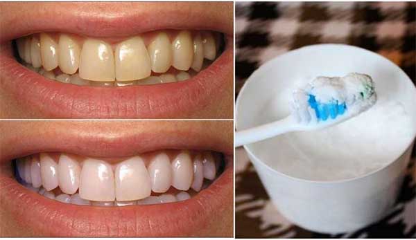 جوش شیرین برای سفید کردن دندان