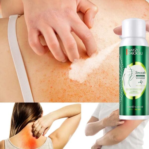 اسپری ضدجوش بدن و پشت SIAYZU RAIOCEU