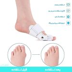 اصلاحکننده انحراف شست پا شست بند طبی پا