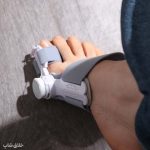 اصلاح انحراف شست پا-آتل انگشت پا درمان هالوکس والگوس
